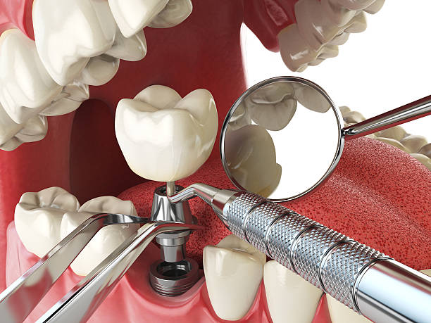 Best Emergency Dentist for Lost Fillings or Crowns in Dawson, TX